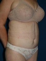 Tummy Tuck