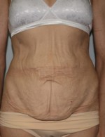 Tummy Tuck