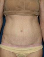 Tummy Tuck