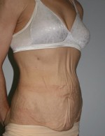 Tummy Tuck