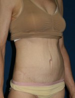 Tummy Tuck