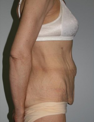 Tummy Tuck