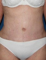 Tummy Tuck