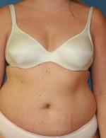 Tummy Tuck
