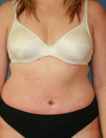 Tummy Tuck