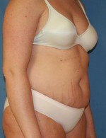 Tummy Tuck