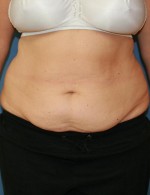 Tummy Tuck