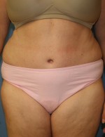 Tummy Tuck