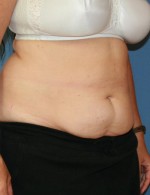 Tummy Tuck