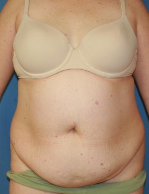 Tummy Tuck