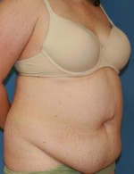 Tummy Tuck