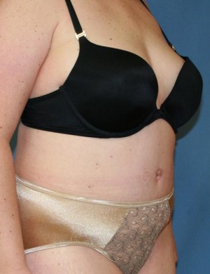 Tummy Tuck