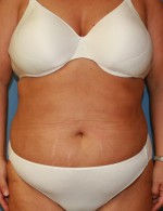 Tummy Tuck