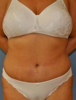 Tummy Tuck