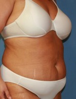 Tummy Tuck
