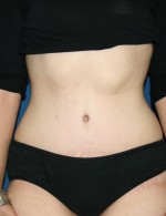 Tummy Tuck
