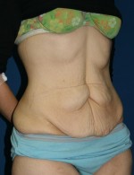 Tummy Tuck