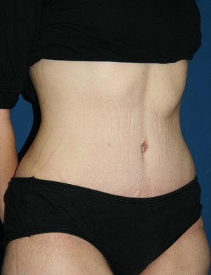 Tummy Tuck