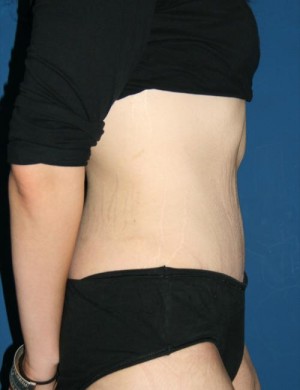 Tummy Tuck