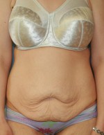 Tummy Tuck