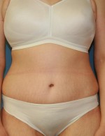 Tummy Tuck