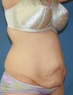 Tummy Tuck
