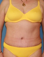 Tummy Tuck