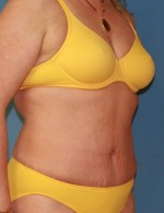Tummy Tuck