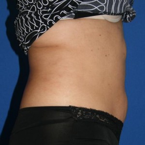 Liposuction