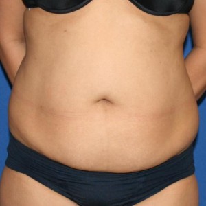 Liposuction