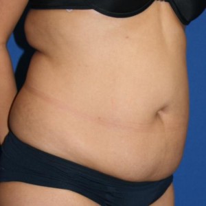 Liposuction