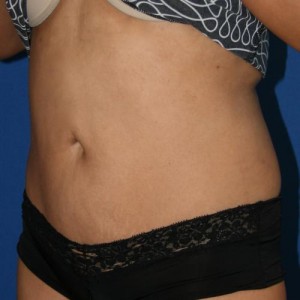 Liposuction