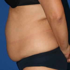 Liposuction