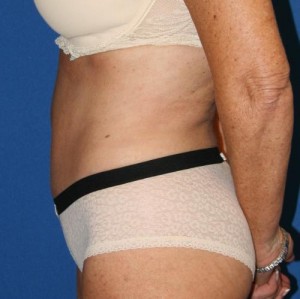 Liposuction