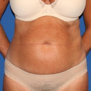 Liposuction