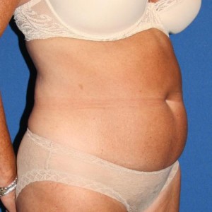 Liposuction