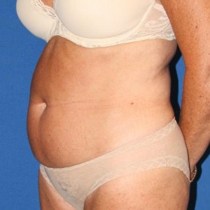 Liposuction