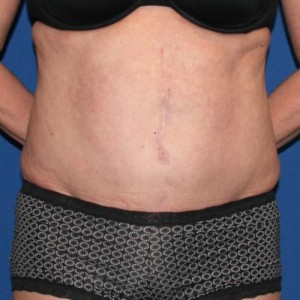 Liposuction