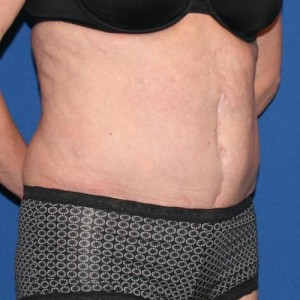 Liposuction