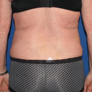 Liposuction