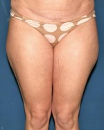 Liposuction