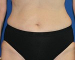 Liposuction