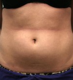 Liposuction