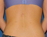 Liposuction
