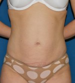 Liposuction
