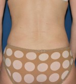 Liposuction