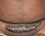 Scar Revision Body Contouring