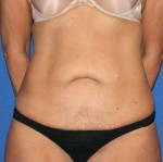 Other Post-Bariatric Procedures