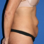 Other Post-Bariatric Procedures