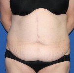 Other Post-Bariatric Procedures